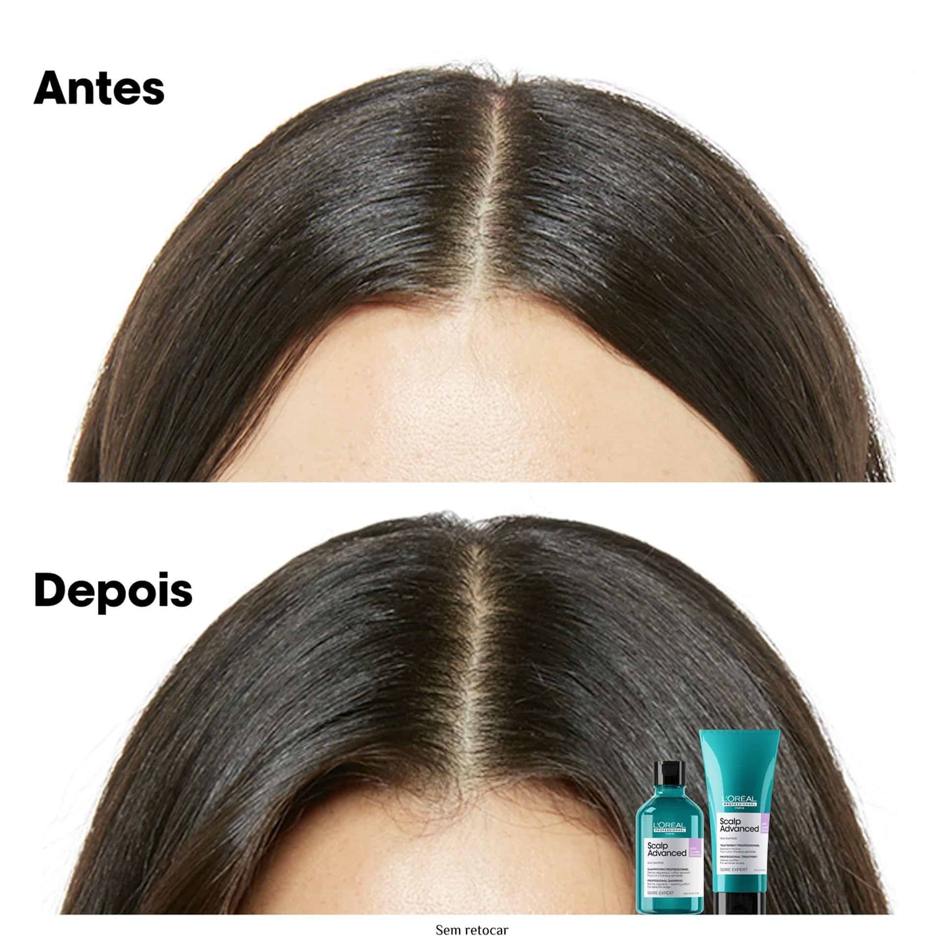 Shampoo Anti Desconforto Scalp Advanced 300ml 