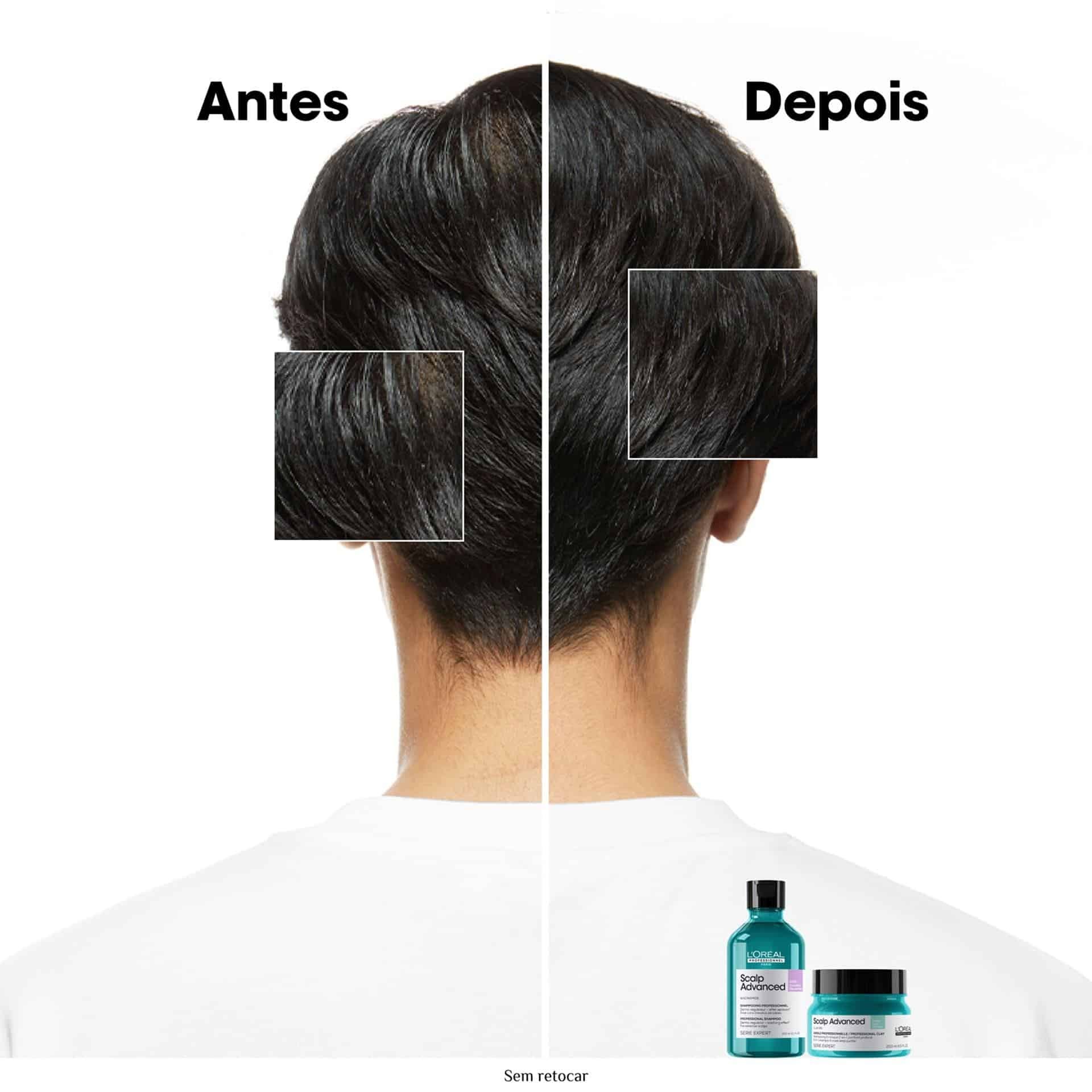 Shampoo Scalp Advanced Anti Oleosidade 300ml