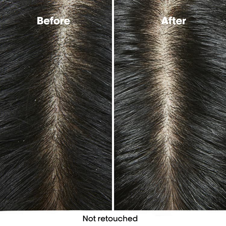Antes e depois do couro cabeludo de uma mulher, visivelmente mais saudável e livre de caspa após seguir uma rotina de cuidados anticaspa.
